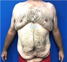 Tummy Tuck Before Photo by Michael Fallucco, MD, FACS; Jacksonville, FL - Case 40623