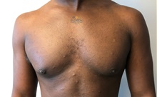 Male Breast Reduction After Photo by Michael Fallucco, MD, FACS; Jacksonville, FL - Case 41107