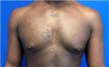 Male Breast Reduction Before Photo by Michael Fallucco, MD, FACS; Jacksonville, FL - Case 41107
