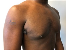 Male Breast Reduction After Photo by Michael Fallucco, MD, FACS; Jacksonville, FL - Case 41107