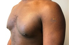 Male Breast Reduction After Photo by Michael Fallucco, MD, FACS; Jacksonville, FL - Case 41107