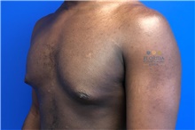 Male Breast Reduction Before Photo by Michael Fallucco, MD, FACS; Jacksonville, FL - Case 41107