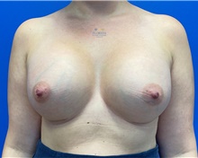 Breast Augmentation After Photo by Michael Fallucco, MD, FACS; Jacksonville, FL - Case 41309