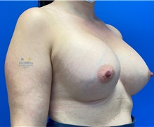 Breast Augmentation After Photo by Michael Fallucco, MD, FACS; Jacksonville, FL - Case 41309