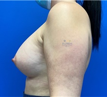 Breast Augmentation After Photo by Michael Fallucco, MD, FACS; Jacksonville, FL - Case 41309