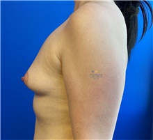 Breast Augmentation Before Photo by Michael Fallucco, MD, FACS; Jacksonville, FL - Case 41309
