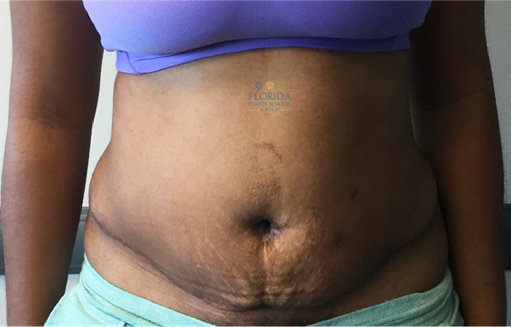 Panniculectomy Before and After Photos by Michael Fallucco, MD