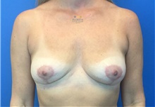 Breast Implant Removal After Photo by Michael Fallucco, MD, FACS; Jacksonville, FL - Case 41890