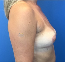 Breast Implant Removal After Photo by Michael Fallucco, MD, FACS; Jacksonville, FL - Case 41890