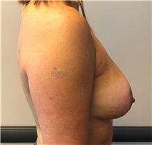 Breast Implant Removal Before Photo by Michael Fallucco, MD, FACS; Jacksonville, FL - Case 41890