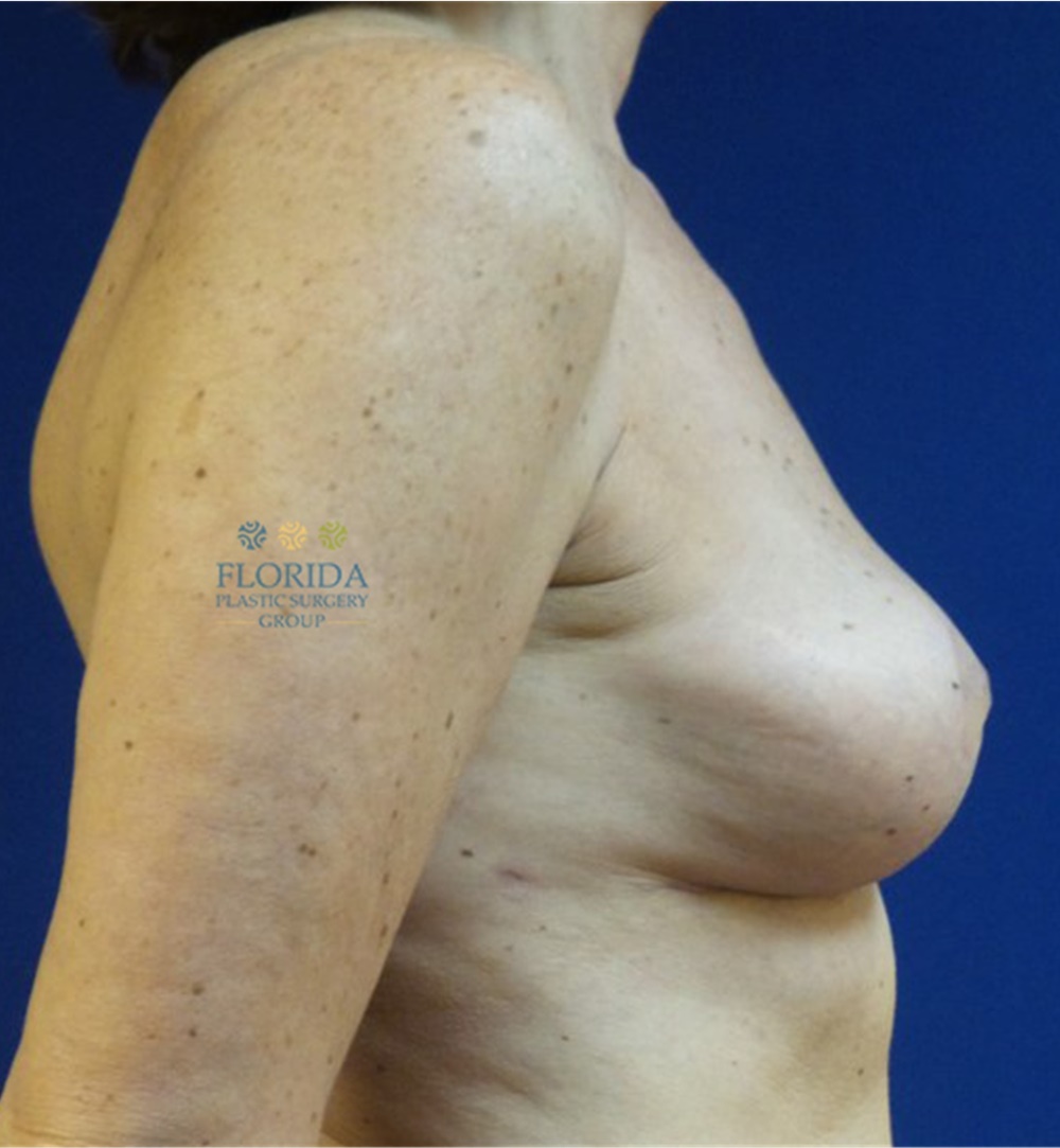 Breast Implant Removal Before and After Photos by Michael Fallucco, MD, FACS; Jacksonville, FL ...