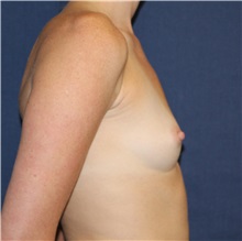 Breast Augmentation Before Photo by Brian Windle, MD; Aspen, CO - Case 32362