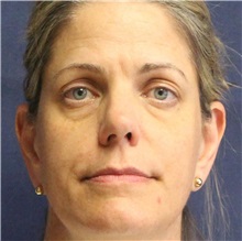 Dermal Fillers Before Photo by Brian Windle, MD; Aspen, CO - Case 32824