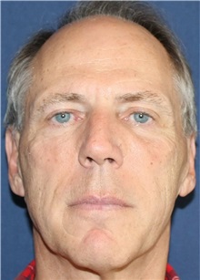 Dermal Fillers After Photo by Brian Windle, MD; Aspen, CO - Case 33388
