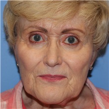 Dermal Fillers Before Photo by Brian Windle, MD; Aspen, CO - Case 33447