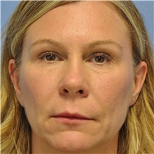 Dermal Fillers Before Photo by Brian Windle, MD; Aspen, CO - Case 33448