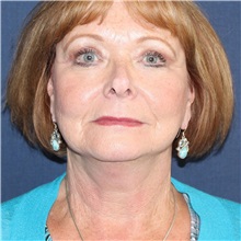 Dermal Fillers After Photo by Brian Windle, MD; Aspen, CO - Case 33564