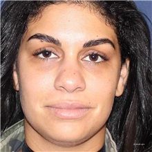 Dermal Fillers After Photo by Brian Windle, MD; ,  - Case 33575