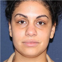 Dermal Fillers Before Photo by Brian Windle, MD; ,  - Case 33575