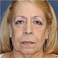 Dermal Fillers Before Photo by Brian Windle, MD; Aspen, CO - Case 33576