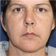 Dermal Fillers Before Photo by Brian Windle, MD; Aspen, CO - Case 33591