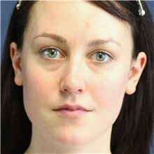 Dermal Fillers Before Photo by Brian Windle, MD; Aspen, CO - Case 33688