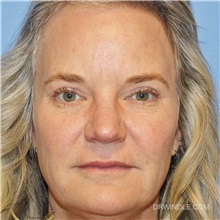 Eyelid Surgery After Photo by Brian Windle, MD; Aspen, CO - Case 36996