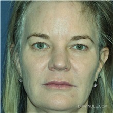 Eyelid Surgery Before Photo by Brian Windle, MD; Aspen, CO - Case 36996