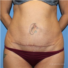 Tummy Tuck After Photo by Brian Windle, MD; ,  - Case 38159