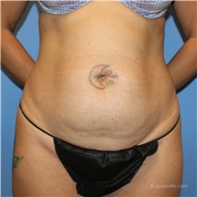 Tummy Tuck Before Photo by Brian Windle, MD; ,  - Case 38159