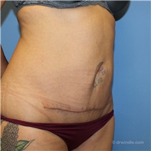Tummy Tuck After Photo by Brian Windle, MD; ,  - Case 38159