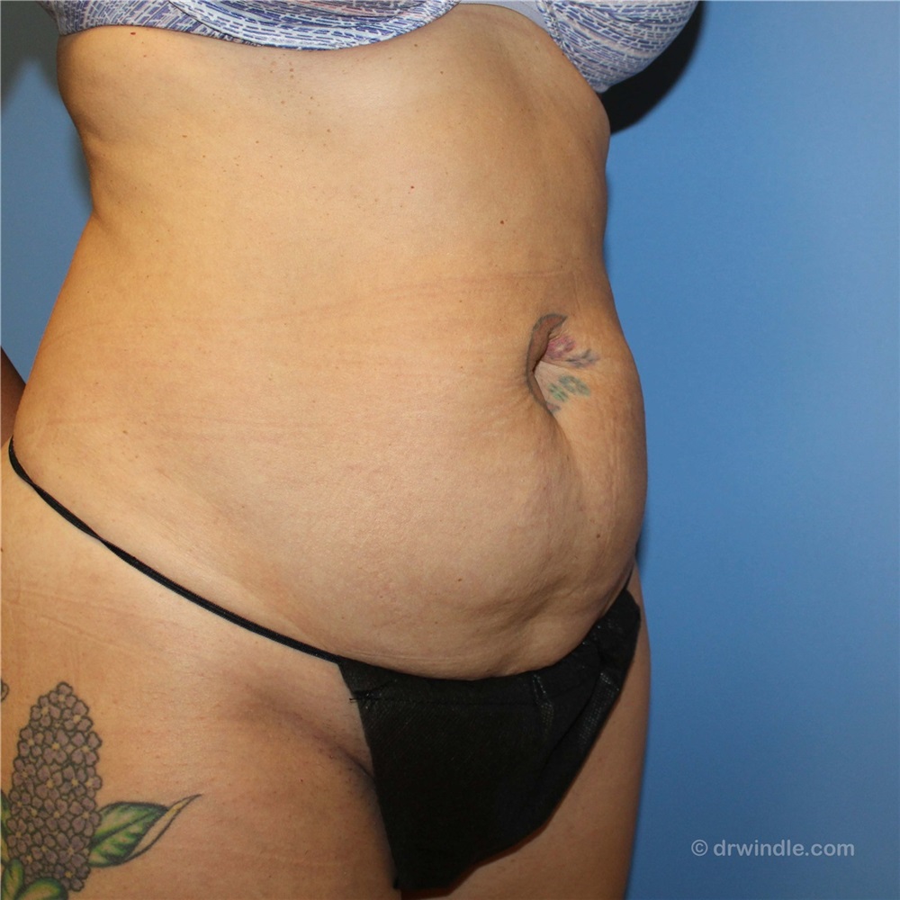 Tummy Tuck, Birmingham, AL