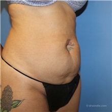Tummy Tuck Before Photo by Brian Windle, MD; ,  - Case 38159