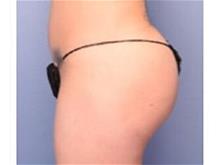 Buttock Lift with Augmentation After Photo by Patrick Hsu, MD; Houston, TX - Case 29955