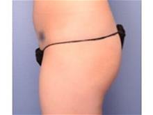 Buttock Lift with Augmentation Before Photo by Patrick Hsu, MD; Houston, TX - Case 29955