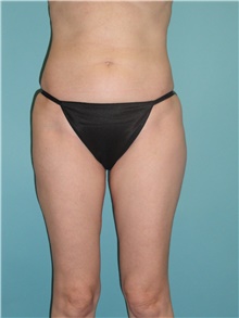 Liposuction After Photo by Theodore Diktaban, MD; New York, NY - Case 40658