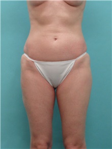 Liposuction Before Photo by Theodore Diktaban, MD; New York, NY - Case 40658