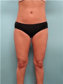 Liposuction After Photo by Theodore Diktaban, MD; New York, NY - Case 40659