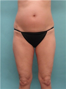 Liposuction Before Photo by Theodore Diktaban, MD; New York, NY - Case 40659