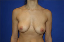 Breast Augmentation Before Photo by Theodore Diktaban, MD; New York, NY - Case 40880