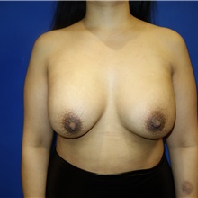 Breast Augmentation After Photo by Theodore Diktaban, MD; New York, NY - Case 40881