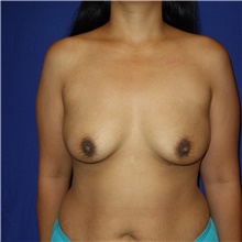 Breast Augmentation Before Photo by Theodore Diktaban, MD; New York, NY - Case 40881