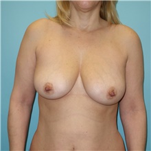 Breast Augmentation Before Photo by Theodore Diktaban, MD; New York, NY - Case 40882