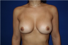 Breast Augmentation After Photo by Theodore Diktaban, MD; New York, NY - Case 40883