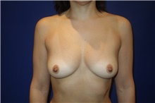 Breast Augmentation Before Photo by Theodore Diktaban, MD; New York, NY - Case 40883