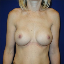 Breast Augmentation After Photo by Theodore Diktaban, MD; New York, NY - Case 40885