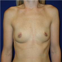 Breast Augmentation Before Photo by Theodore Diktaban, MD; New York, NY - Case 40885