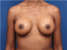 Breast Augmentation After Photo by Theodore Diktaban, MD; New York, NY - Case 40886