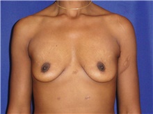 Breast Augmentation Before Photo by Theodore Diktaban, MD; New York, NY - Case 40886