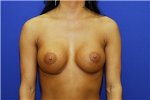 Breast Augmentation Before Photo by Theodore Diktaban, MD; New York, NY - Case 40887